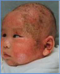 Secondary bacterial infection 